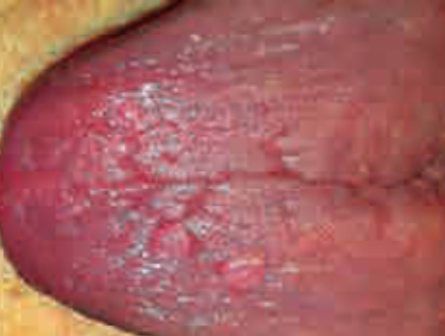 Papilloma a cellule squamose Papilloma a cellule squamose lingua Sintomi tumore prostata avanzato