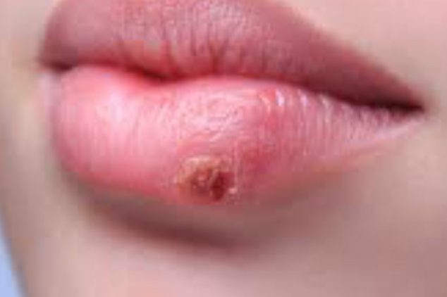 Herpes-labialis