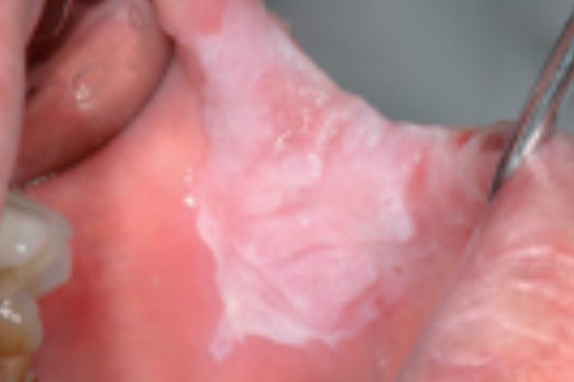Leucoplachia-omogenea