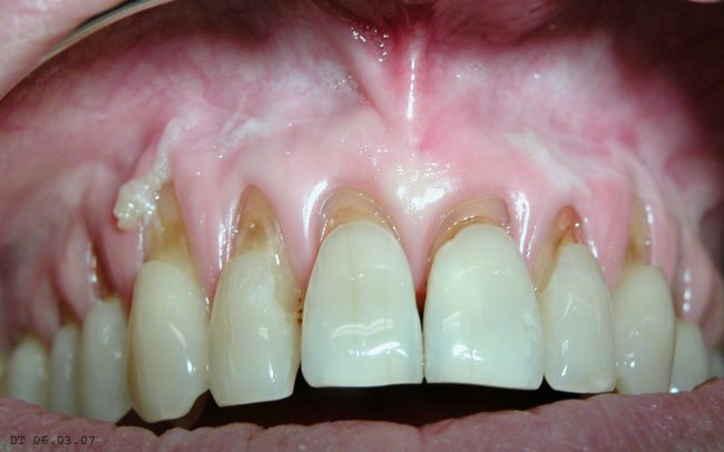 Membrana mucosa da collutorio