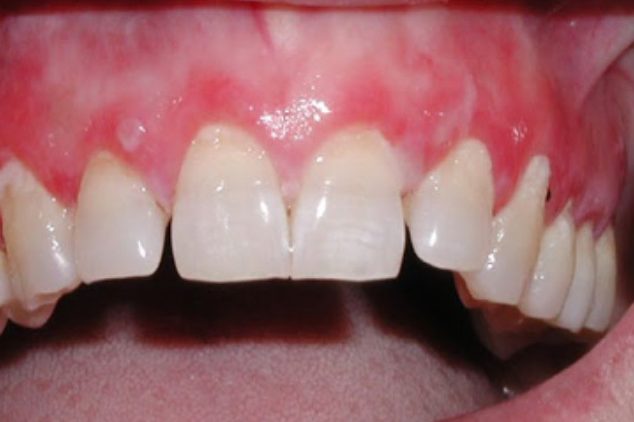 PMM-con-aspetto-di-gengivite-desquamativa