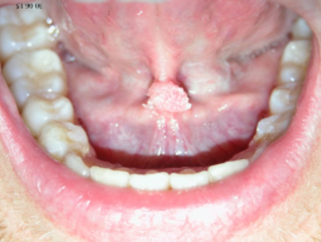 lesioni papilloma virus bocca