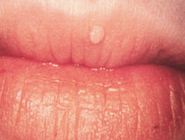 Papilloma virus nella saliva
