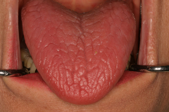 Xerostomia